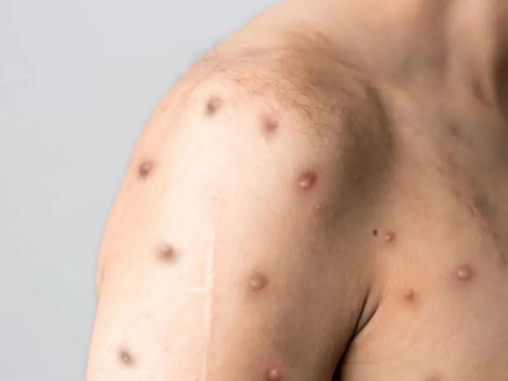 Nova cepa do vírus da Mpox recombinante preocupa OMS e testes mostram que antiviral mais usado não é eficaz