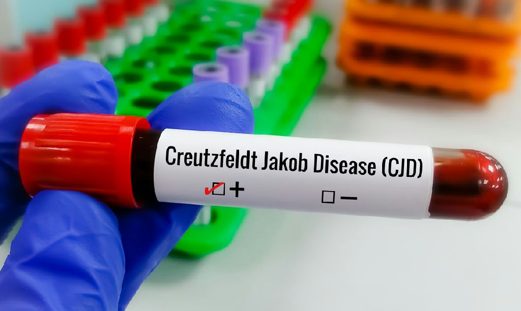 Doença de Creutzfeldt-jakob: o que se sabe sobre a condição rara e degenerativa