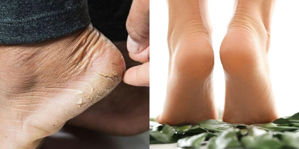 Cuidados com os pés: como a vaselina auxilia na recuperação de calcanhares rachados