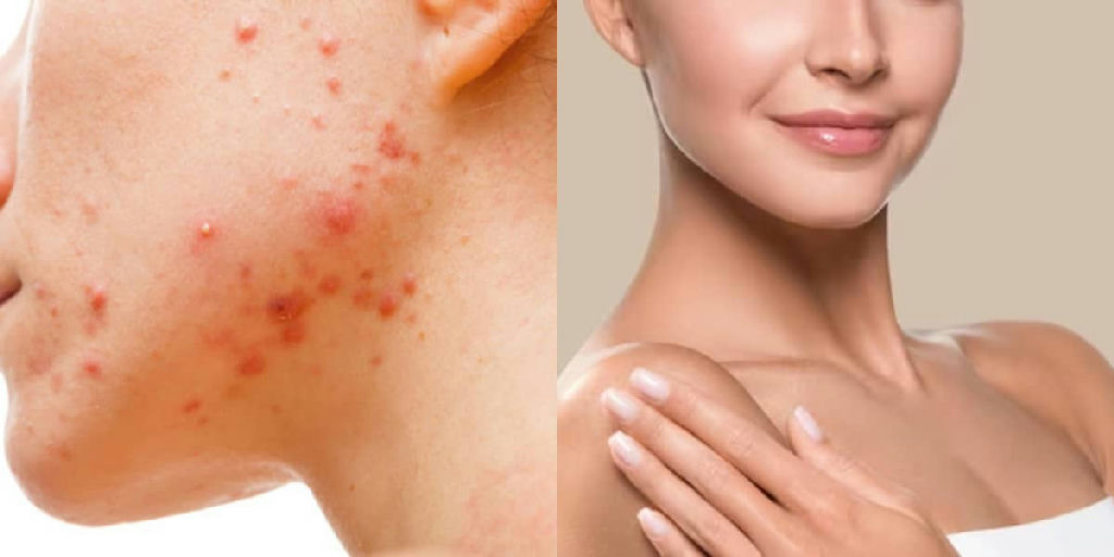 Novo sérum multifuncional une ativos potentes para combater acne e manchas na pele