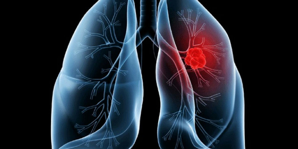 Entenda o adenocarcinoma pulmonar, tipo de câncer que levou o Papa Leão à mesa de cirurgia