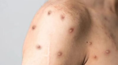 Nova cepa do vírus da Mpox recombinante preocupa OMS e testes mostram que antiviral mais usado não é eficaz