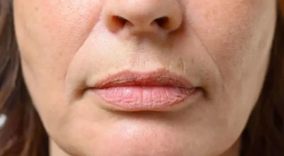 Bigode chinês: conheça 3 erros comuns que acentuam as linhas de expressão no rosto