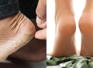 Cuidados com os pés: 3 opções de cremes para tratar o ressecamento e rachaduras