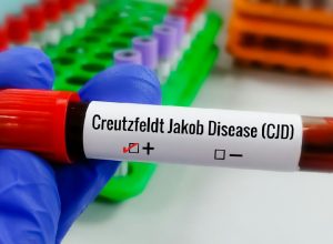 Doença de Creutzfeldt-jakob: o que se sabe sobre a condição rara e degenerativa