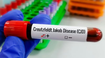 Doença de Creutzfeldt-jakob: o que se sabe sobre a condição rara e degenerativa