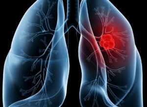 Entenda o adenocarcinoma pulmonar, tipo de câncer que levou o Papa Leão à mesa de cirurgia