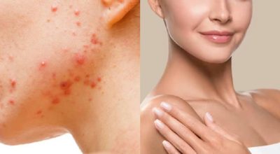 Novo sérum multifuncional une ativos potentes para combater acne e manchas na pele