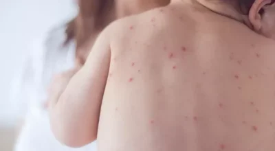 Sarampo em São Paulo: estado registra 32 casos confirmados em 2026