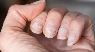 Unhas descamando: entenda as causas e como recuperar a saúde das mãos