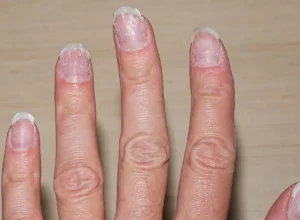 Unhas fracas e quebradiças: 5 hábitos essenciais para recuperar a resistência